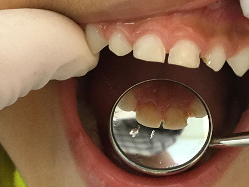3-year-old boy with clean teeth image